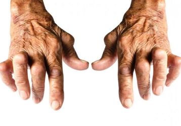 Серопозитивный ревматоидный артрит: что такое, симптомы и лечение