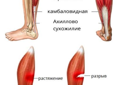 Растяжение связок коленного сустава первая помощь и лечение