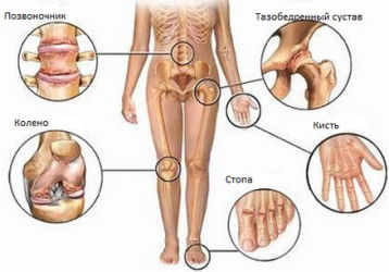 Симптомы и признаки блуждающего артрита, лечение и профилактика