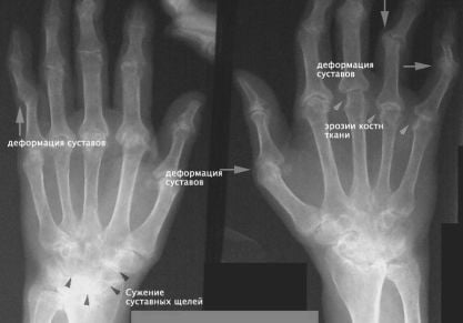 Симптомы и лечение основных болезней суставов рук: список распространенных