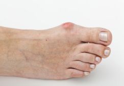 Болит косточка на ноге около большого пальца: лечение, причины и симптомы заболевания, как лечить недуг