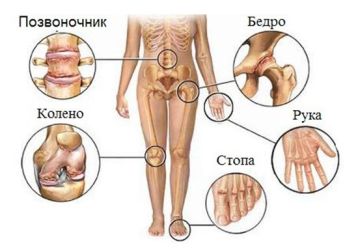 Как лечить хламидийный артрит: симптомы и признаки болезни, диагностика, методы лечения