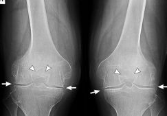 Артроз коленного сустава: лечение в домашних условиях, как лечить недуг