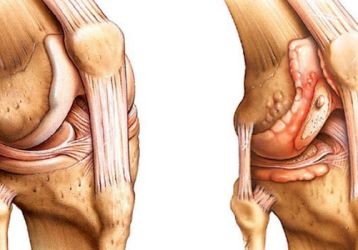 Чем отличается артрит от артроза коленного сустава: анализ признаков болезней