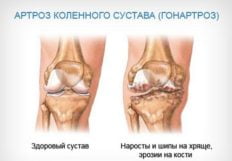 Лечении суставов с использованием народной медицины