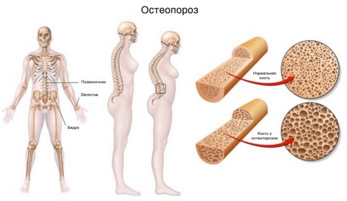 Препараты кальция для профилактики остеопороза, какой кальций ...