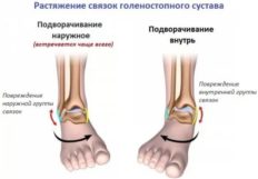 Сильно отекают и болят голеностопные суставы причина лечение блокада суставов межпозвонковых