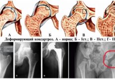 Растяжение связок коленного сустава лечение народными средствами