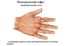 Косточка на большом пальце ноги психосоматика