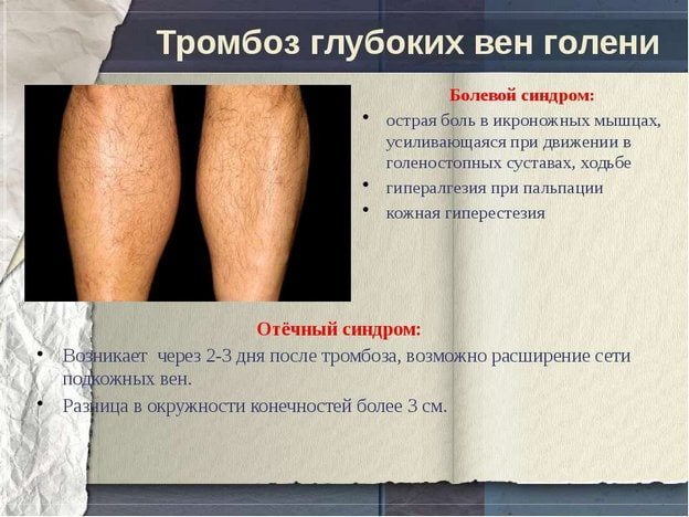 Тромбоз глубоких вен голени Тромбоз нижних конечностей