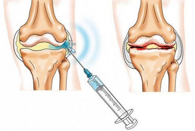 Уколы в коленный сустав при артрозе: препараты, инъекции в колено