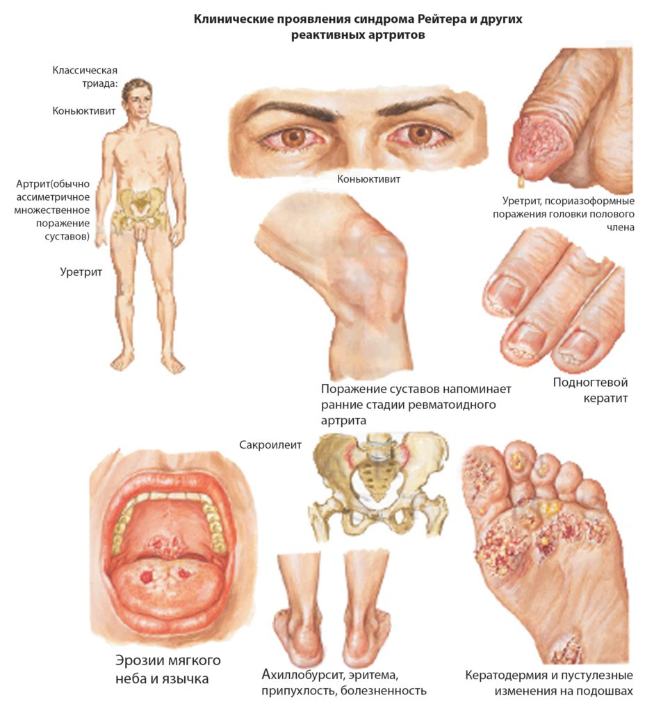 болезнь Рейтера – осложнение хламидиоза