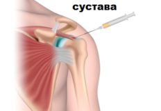 Остеоартроз коленного сустава 2 степени лечение эффективными методами