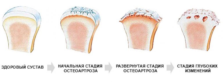 Остеофит височно-нижнечелюстного сустава работа голеностопного сустава