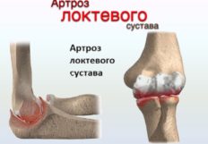 Боли в суставах ног причины и лечение. Почему болят суставы ног