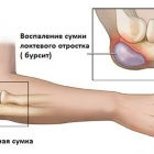 Бурсит локтевого сустава — симптомы и лечение, причины возникновения