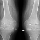 Упражнения при артрозе колена, их виды, особенности выполнения и ожидаемые результаты от лечения