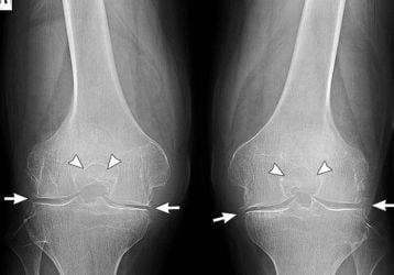 Эндопротезирование коленного сустава: подробное руководство к операции