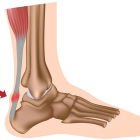 Растяжение ахиллова сухожилия: симптомы и лечение. Отличия от разрыва
