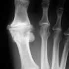 Лечение подагры при обострении в домашних условиях: действенные рецепты