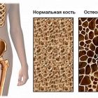 Питание и диета при остеопорозе у женщин и мужчин: что можно и что нельзя есть