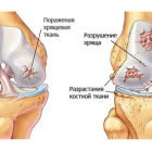 Что такое хондропатия коленного сустава: основные методы диагностики и лечения