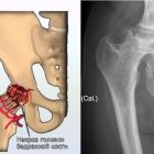 Причины боли в тазобедренном суставе, отдающей в ногу: симптомы заболеваний, лечение