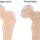 Остеопороз — симптомы и лечение, полное описание заболевания