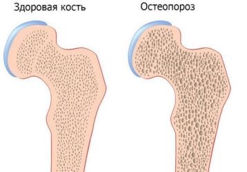 Остеопороз — симптомы и лечение, полное описание заболевания