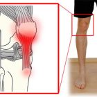 Воспаление сухожилий — тендинит: лечение, что это такое, причины и симптомы патологии