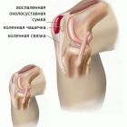 Бурсит коленного сустава — полное описание заболевания, симптомы и лечение