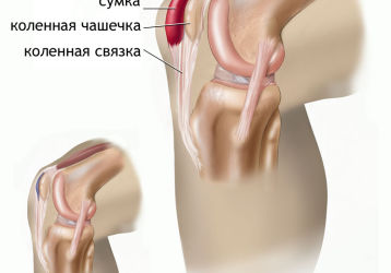 Бурсит коленного сустава — полное описание заболевания, симптомы и лечение