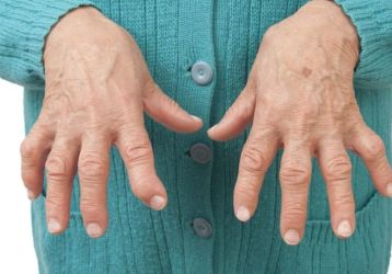 Ревматоидный артрит пальцев рук — первые симптомы, методы лечения