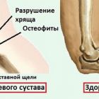 Артроз локтевого сустава: причины, симптомы, лечение, диагностика, полное описание болезни