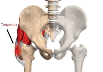 Что такое тендиноз тазобедренного сустава и как его лечить?