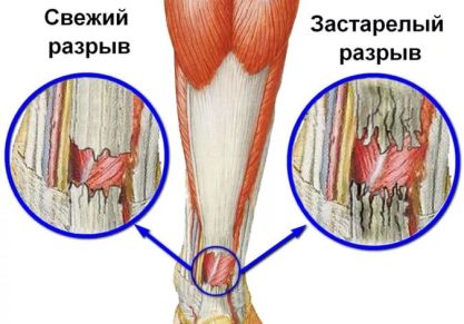 Разрыв ахиллова сухожилия: симптомы, лечение и последствия травмы