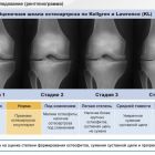 Гонартроз 2 степени: причины, симптомы, методы лечения