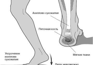 Бурсит стопы — причины, симптомы и методы лечения