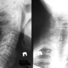 ВСД и шейный остеохондроз — симптомы, лечение