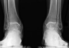 Воспаление голеностопного сустава — причины и лечение заболевания