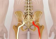 Защемление нерва в тазобедренном суставе: причины, симптомы и лечение ущемления