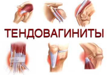 Тендовагинит сухожилий — причины, виды, симптомы, лечение заболевания