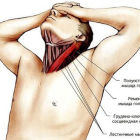 Как лечить растяжение мышц шеи: причины, симптомы и методы лечения