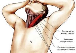Как лечить растяжение мышц шеи: причины, симптомы и методы лечения