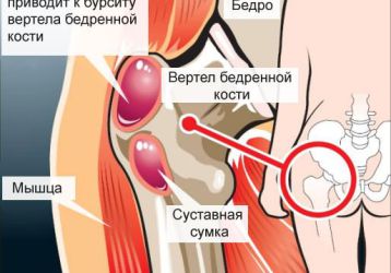 Симптомы и лечение бурсита тазобедренного сустава: возможные осложнения