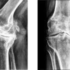 Массаж при артрозе коленного сустава: как правильно выполнять, виды, противопоказания