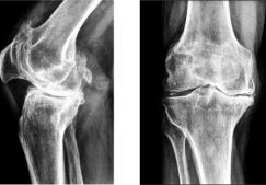 Массаж при артрозе коленного сустава: как правильно выполнять, виды, противопоказания