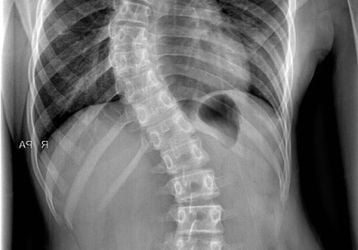 Сколиоз позвоночника: симптомы, виды, последствия и осложнения