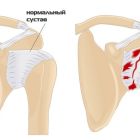 Адгезивный капсулит плечевого сустава: симптомы, диагностика и лечение