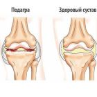 Что такое подагра коленного сустава: симптомы болезни, как и чем лечить